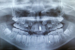 歯周病治療計画プラン